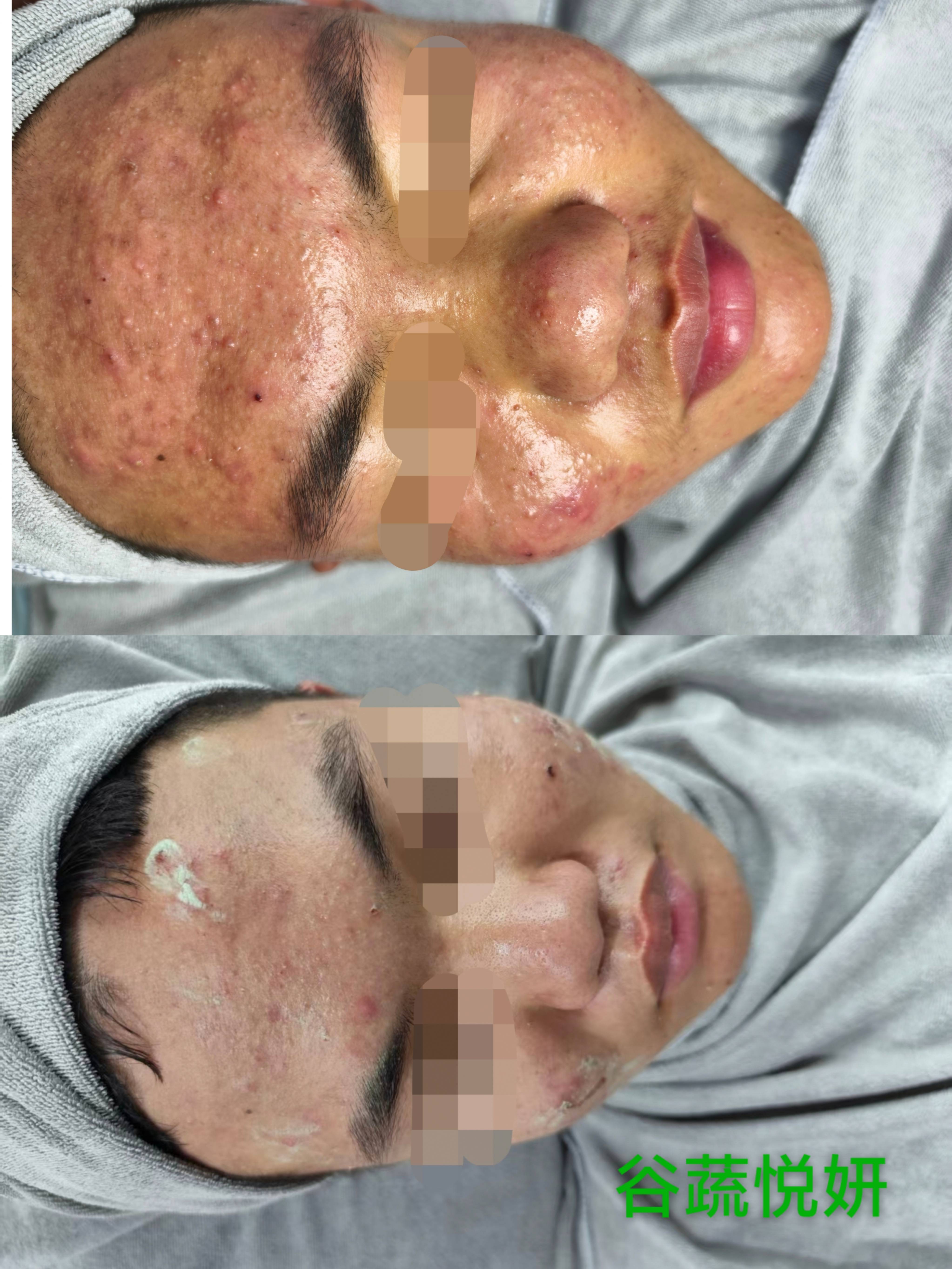 护肤前后对比照片