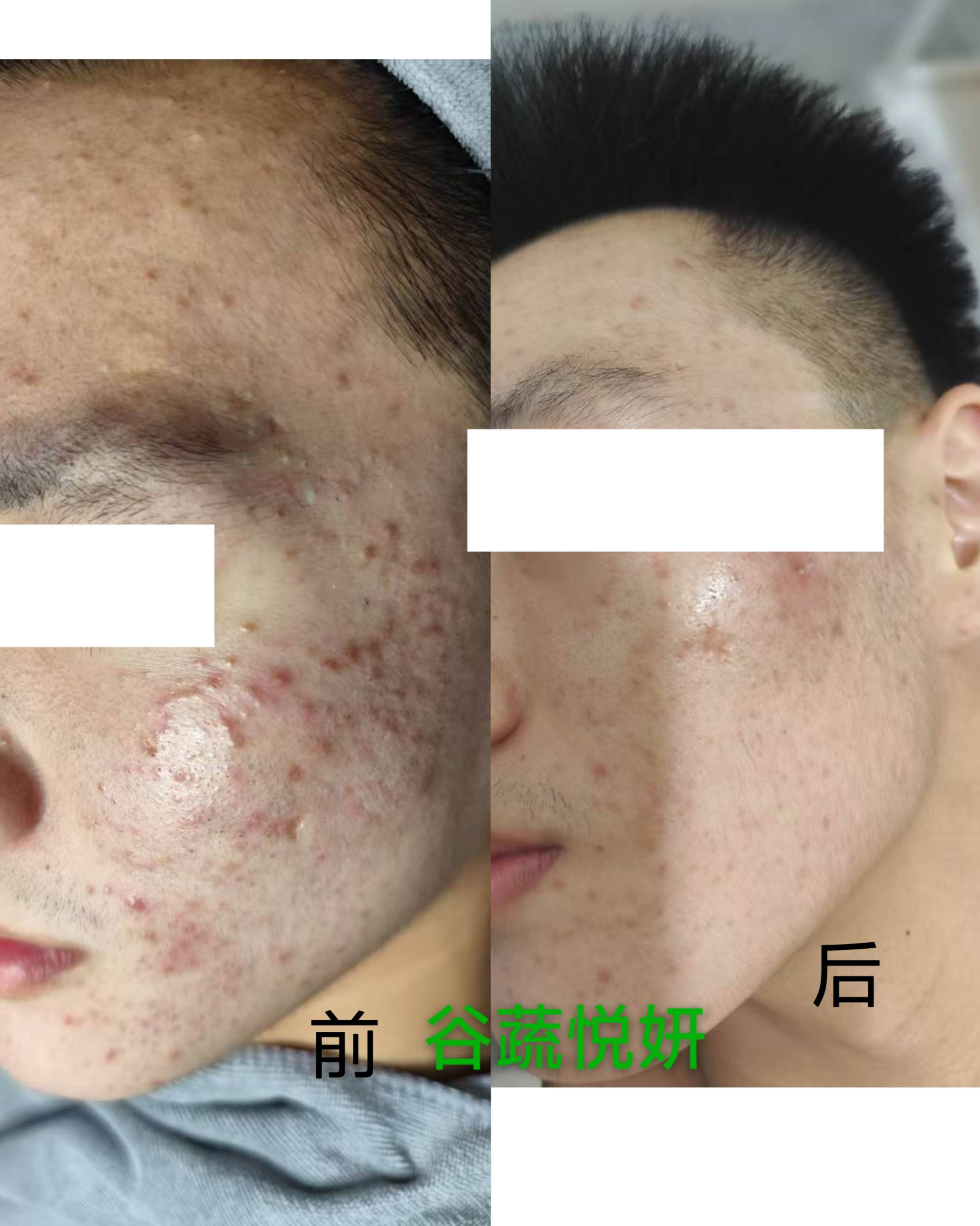 护肤前后对比照片
