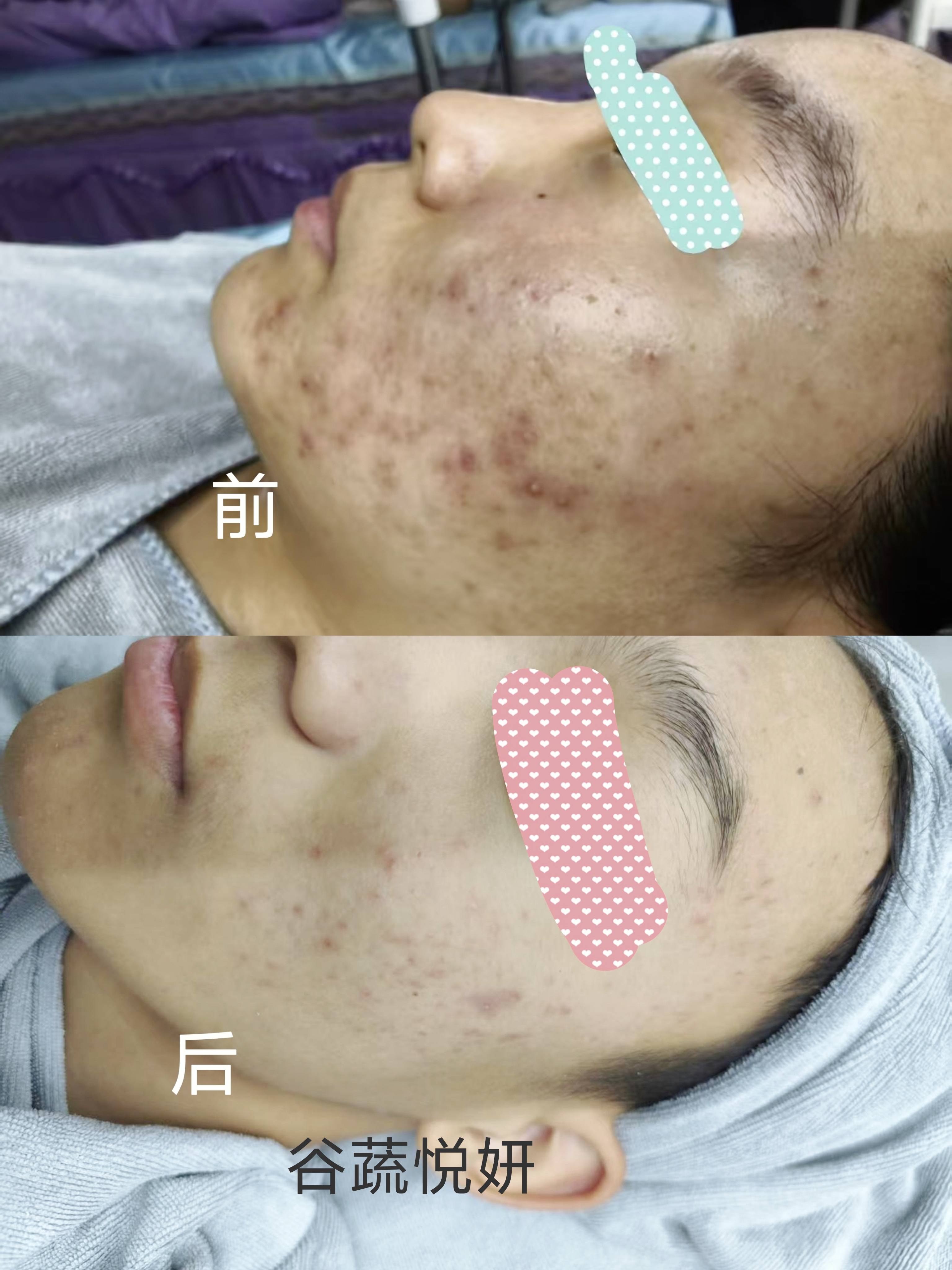 护肤前后对比照片
