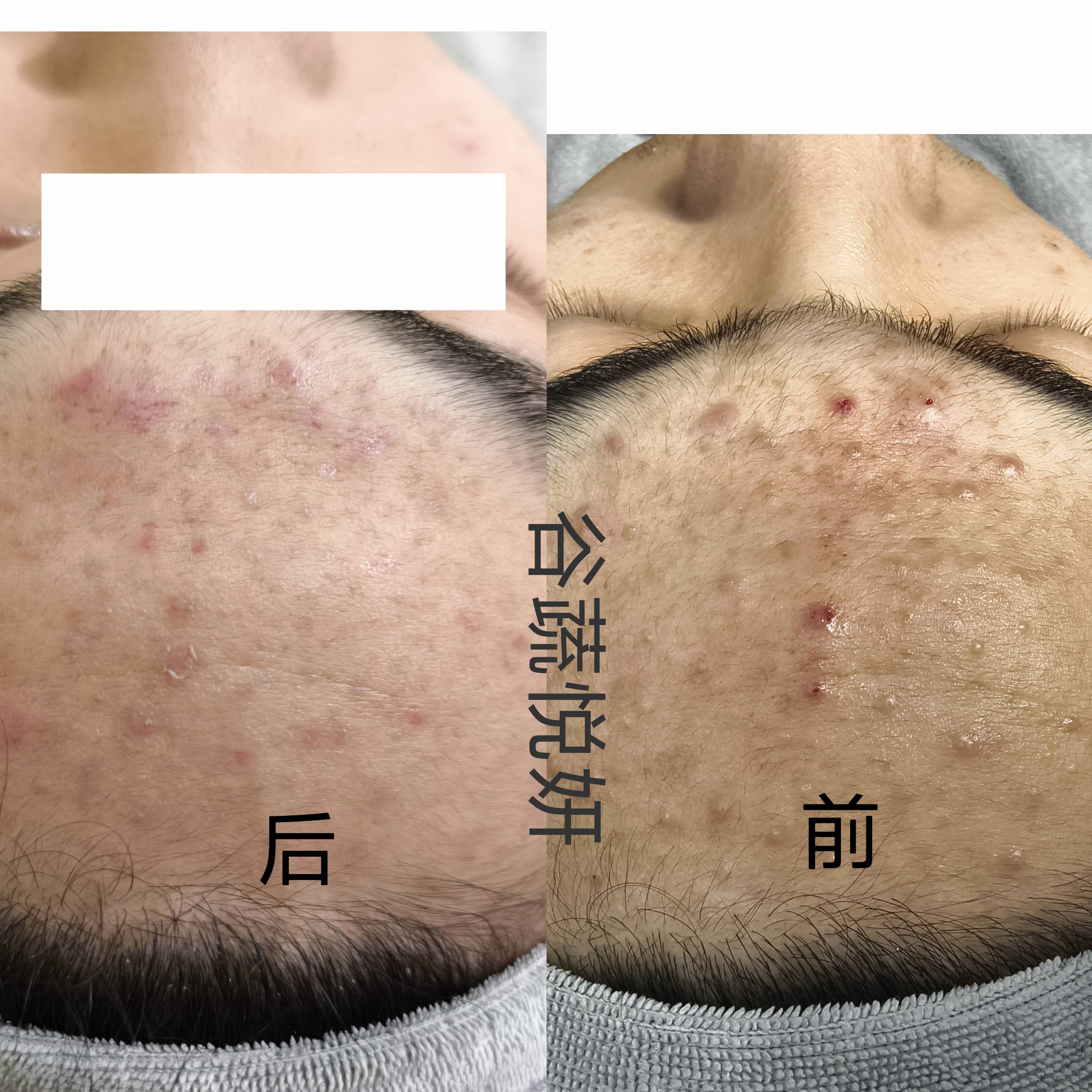 护肤前后对比照片